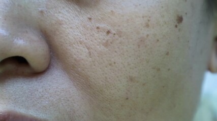 A close-up shot of a woman's cheek, showcasing detailed skin textures with milia, melanoma, and freckles. The image highlights natural skin imperfections.