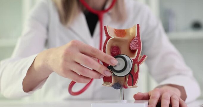Doctor holds model of unhealthy lower rectum with inflamed vascular structures