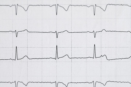Elektrokardiografia EKG badanie , krzywa rytmu serca wydruk na papierze