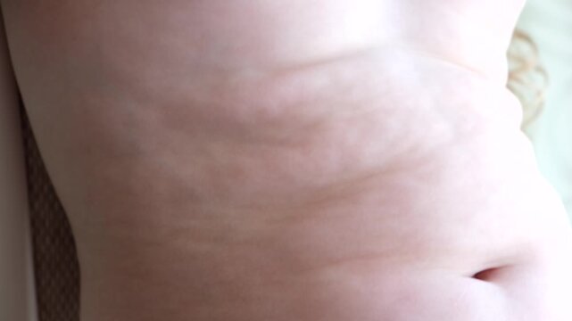 baby belly with folds and celluite, childhood obesity due to poor nutrition, hormonal imbalance in a child