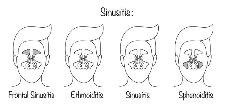 Types of sinusitis
