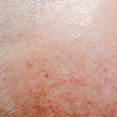 Fototapeta premium Actinic keratosis or basal cell carcinoma on the scalp of an adult