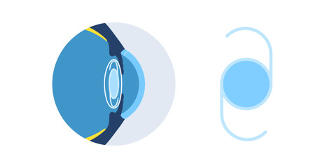 Intraocular lens poster