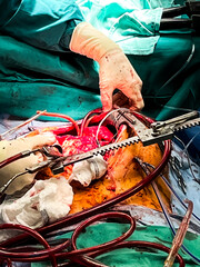 Coronary Artery Bypass Surgery with Mitral Valve Replacement 