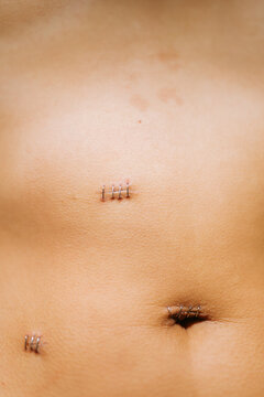 Laparoscopic Suture Scars