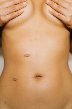 Laparoscopic Surgery Scars