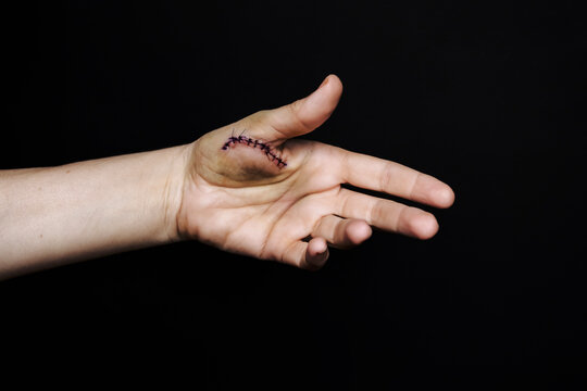 Stitches