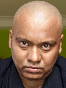 A bald headed man with angry facial expression