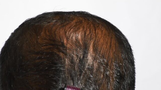 close up of young man Micro needling, using derma roller on head for stimulating new hair growth and reduce hair loss or Androgenetic alopecia. derma roller on bald area improve hair regrowth therapy