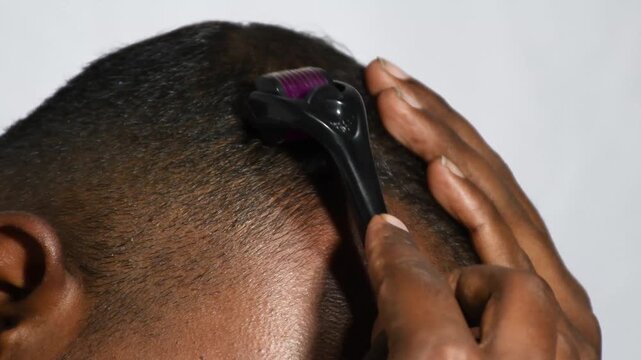 close up of young man Micro needling, using derma roller on head for stimulating new hair growth and reduce hair loss or Androgenetic alopecia. derma roller on bald area improve hair regrowth therapy
