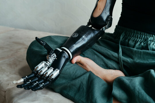 Person With Prosthetic Arm Sitting