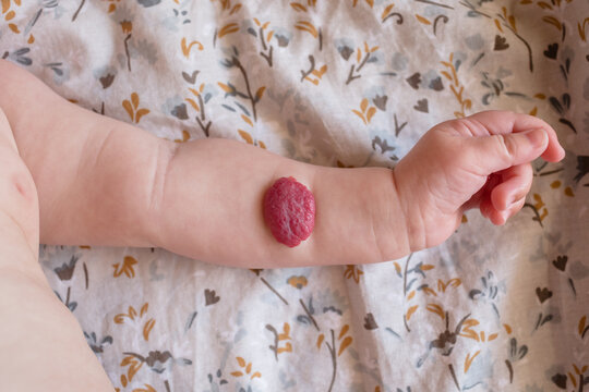  Baby hand with hemangioma