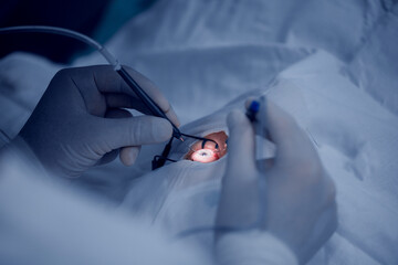 Lasik treatment, laser vision correction. Doctor performs operation replacement of lens in eye and...