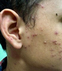 Chicken pox infection at face.