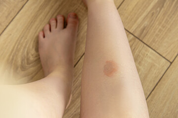 Large red spot on the leg. Skin disease or insect bite mark. Allergic spot