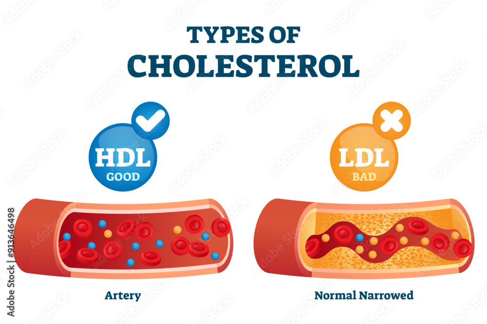 Poster types of cholesterol comparison with hdl and ldl lipoprotein illustration, transparent background. l