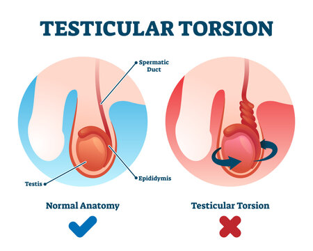 Testicular torsion illustration, transparent background. Labeled spermatic cord twist diagnosis scheme. Compared educational normal and abnormal anatomy.