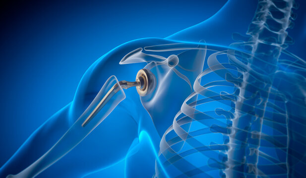Shoulder joint replacement implant - X-ray view - Medically 3D illustration with blue background