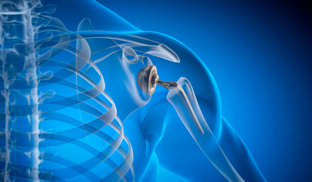 Shoulder joint replacement implant - X-ray view - Medically 3D illustration with blue background