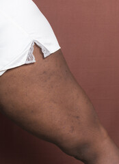 Eczema on brown skin leg, brown skin with hyperpigmentation and scarring from eczema and atopic...