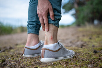 Guy worried about wound on leg needing urgent treatment of bite with soothing balm against itching,...