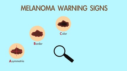 ABCDE rule of skin cancer. Skin cancer symptoms. Warning signs of a melanoma. Asymmetrie, Border, Color, Diameter and Evolving. Health care themed animation.