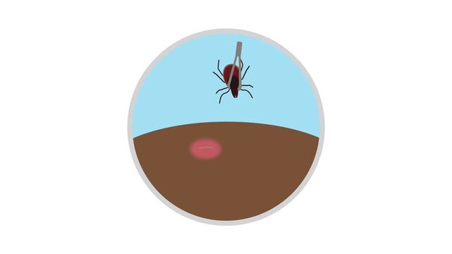 Tick removal animation. Tweezers appearing on screen, removing a tick from the skin. White background and green screen background.