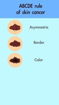 Vertical video: ABCDE rule of skin cancer. Skin cancer symptoms. Warning signs of a melanoma. Asymmetrie, Border, Color, Diameter and Evolving. Health care themed animation.