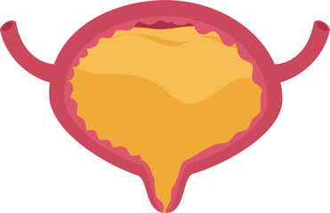 Urinary bladder disease. Full bladder Illustration.