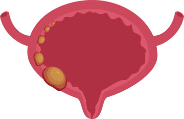 Urinary bladder disease. Bladder cancer Illustration.
