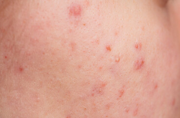 Skin texture background. Closeup acne pimple. Treatment for skin. Problem skincare. Pimples, acne,...