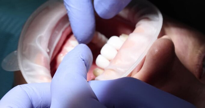 Dentist hand presses on patient teeth checking sensitivity before procedure. Doctor takes ultrasonic cleaner to remove plaque in open oral cavity