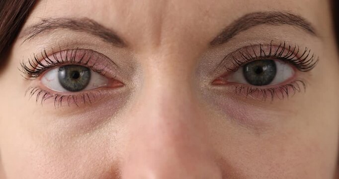 Closeup of woman eyes blinking and inflamed red eye vessels