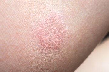 Skin allergy rash dermatitis texture close up