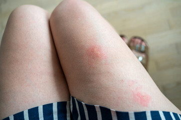 Close-up view of person legs wearing shorts, with two large, red mosquito bites. Bites inflamed and clearly visible against skin