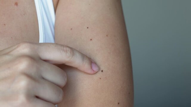 Young woman demonstrating a large number of moles on her arms on grey background. The effect of sunlight on the skin. A girl counting her moles on her body by pointing at them with her finger