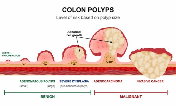 Colon Polyps Cancer Illustration