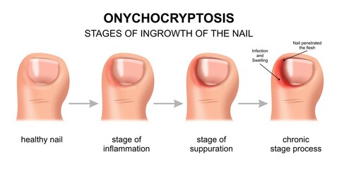 Onychogryphosis toenail illustration infection Stages on ingrowth © KAMAKSI