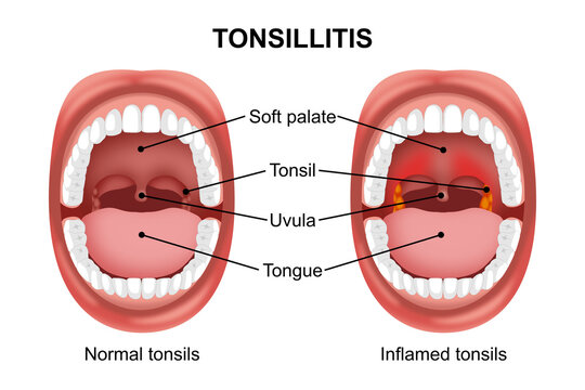 Tonsillitis in mouth illustration infection