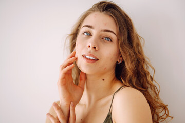 Fototapeta premium Portrait of a beautiful young woman with inflammations on the skin of her face. Pimples. Acne disease. Medicine and cosmetology. 