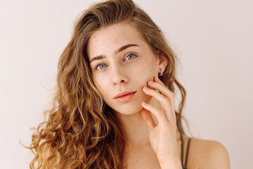 Portrait of a beautiful young woman with inflammations on the skin of her face. Pimples. Acne...