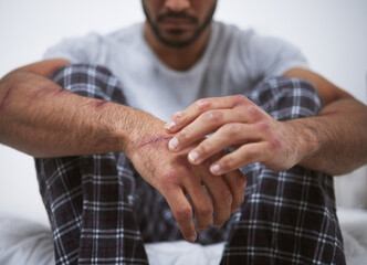 Man, sad and hand scratch for depression, anxiety and trauma as patient with fear, scar and...