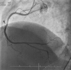Coronary angiogram (CAG) was performed right coronary artery (RCA) stenosis.