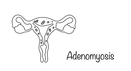 Adenomyosis