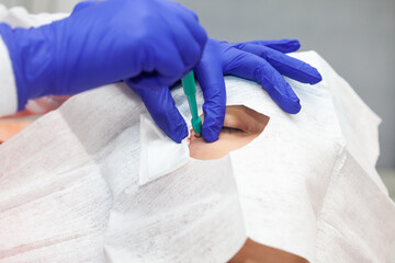 Skin lesion removal procedure. Dermatologist carrying out a removal of benign skin lesion on the face of a young male patient. Biopsy punch