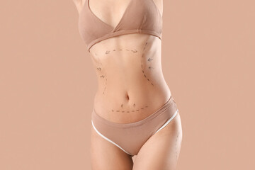 Young woman in underwear with marks on her body against beige background. Plastic surgery concept