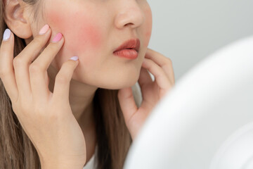 Woman worried about face Dermatology, rosacea dermatitis, allergic steroids, sensitive skin, red...