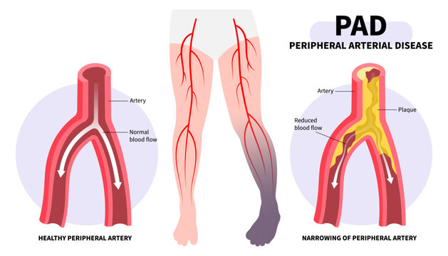 Foot pain with Peripheral artery disease and fatty clot in leg veins or injury that cause high blood pressure