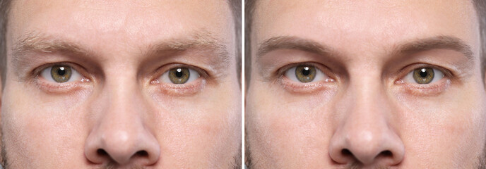 Man before and after permanent eyebrow procedure, collage with closeup photos