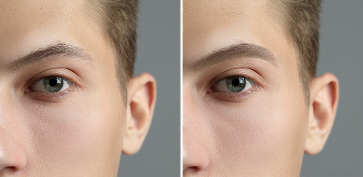 Man before and after permanent eyebrow procedure, collage with closeup photos